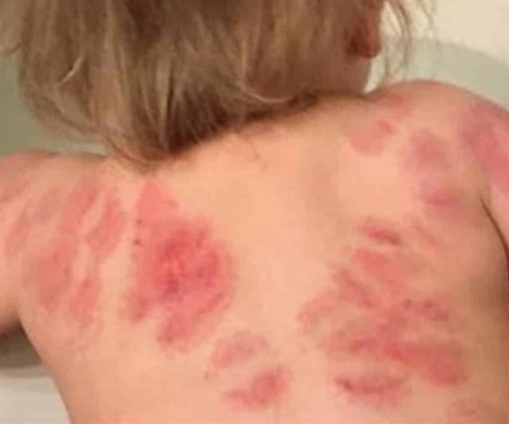 child bitten many times by another toddler at childcare